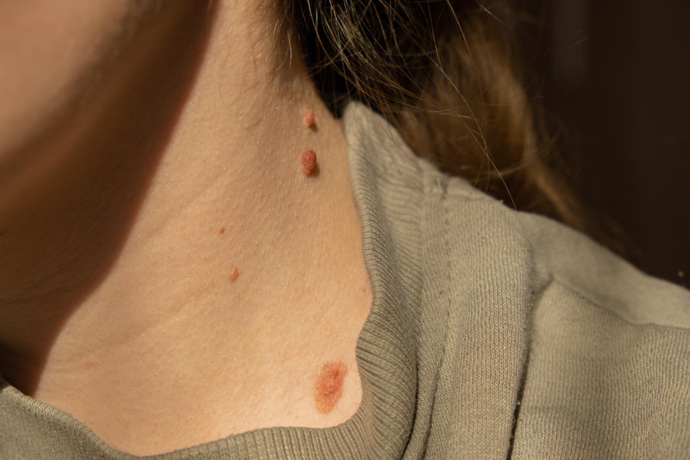 Moles & Hemangioma