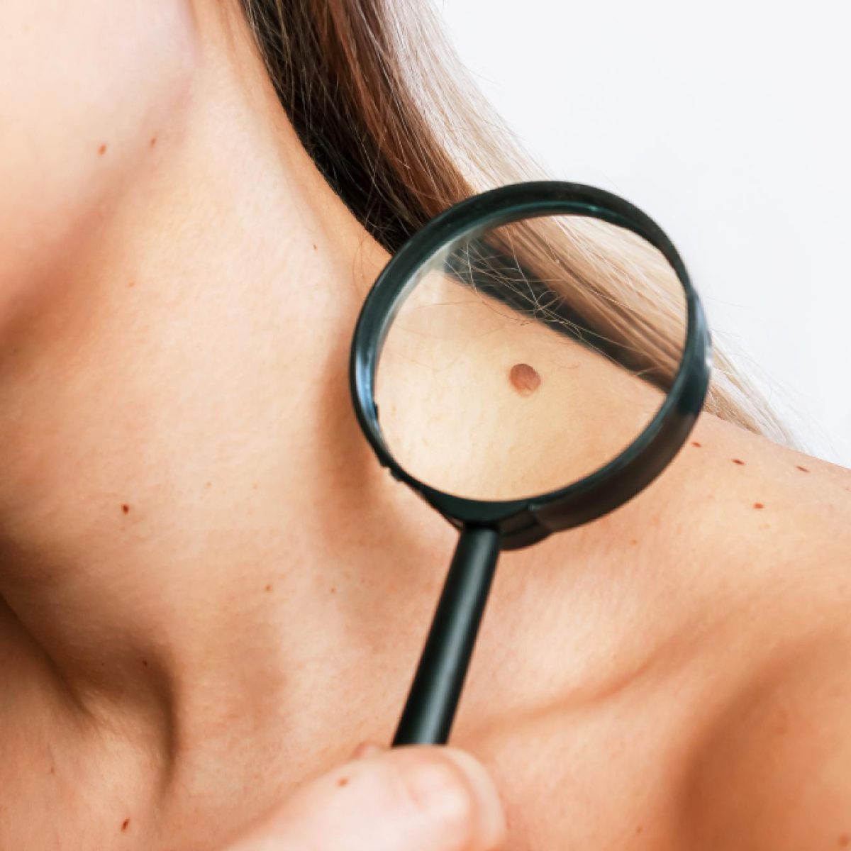 Skin Tags