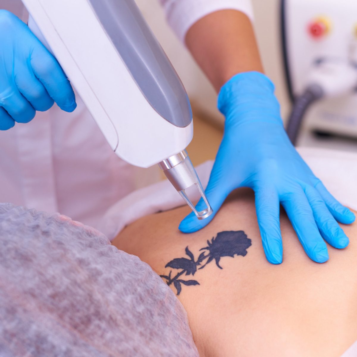 Tattoo Removal