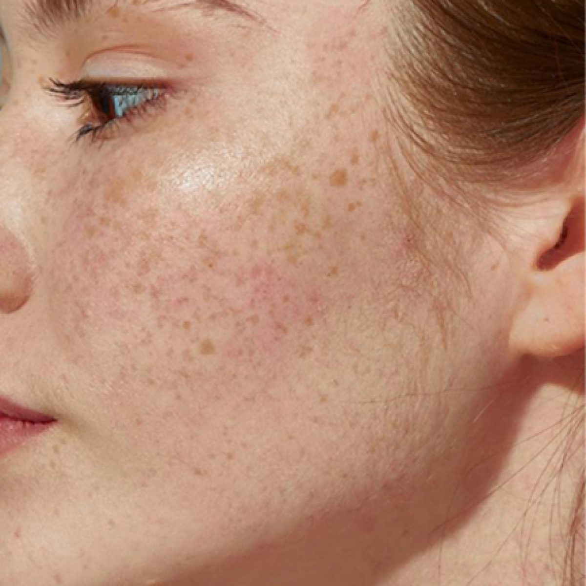 Pigmentation & Dark Spots