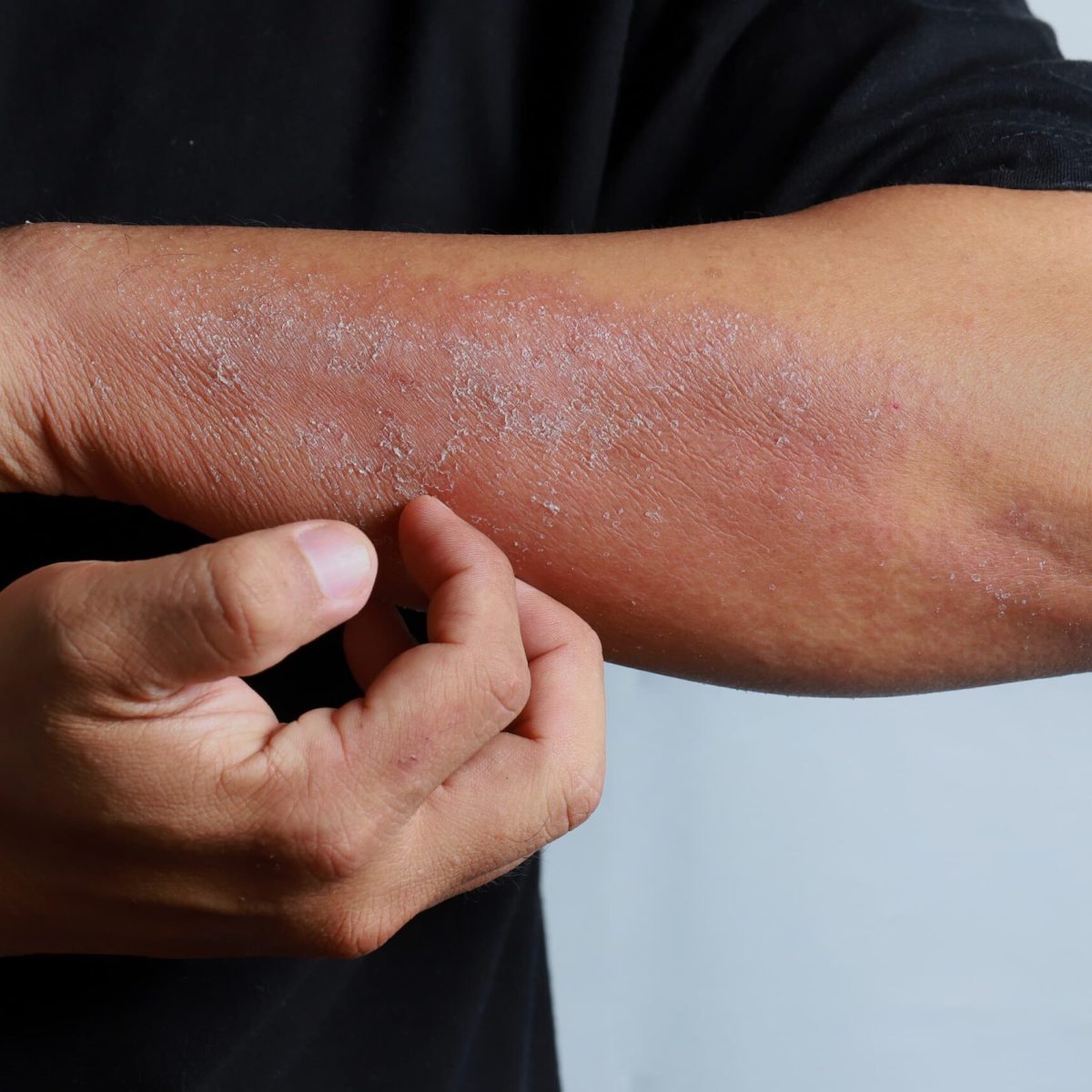 dermatitis