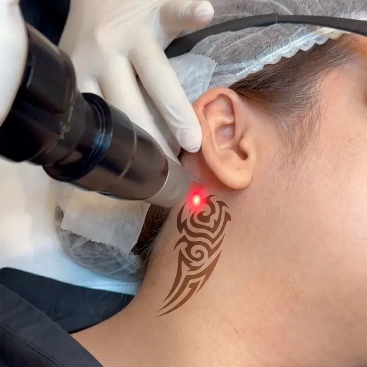 Tatto Removal by Picosure Pro
